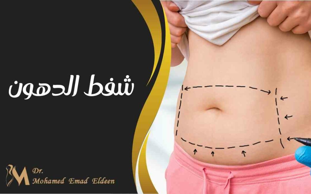 شفط الدهون