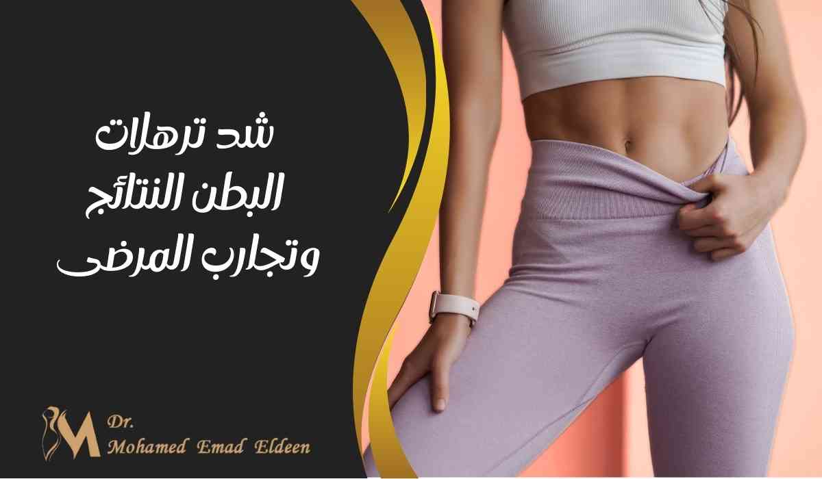 شد-ترهلات-البطن-النتائج-وتجارب-المرضى