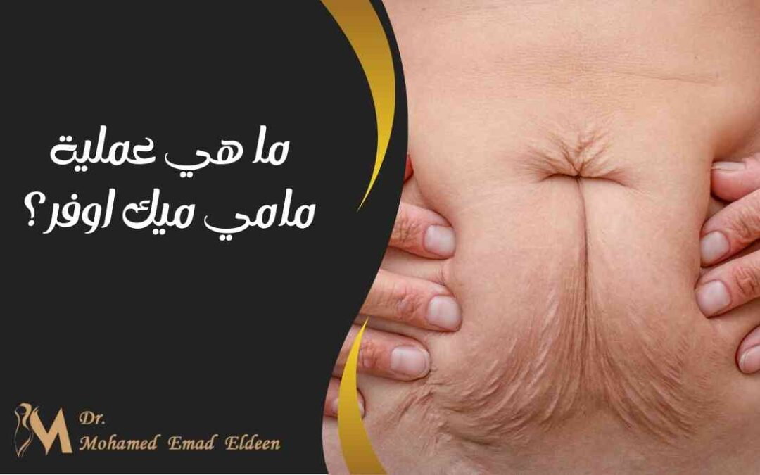 ما هي عملية مامي ميك اوفر؟