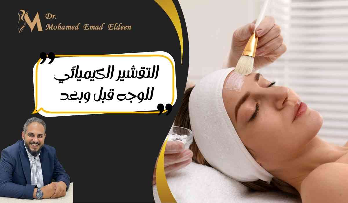 التقشير-الكيميائي-للوجه-قبل-وبعد