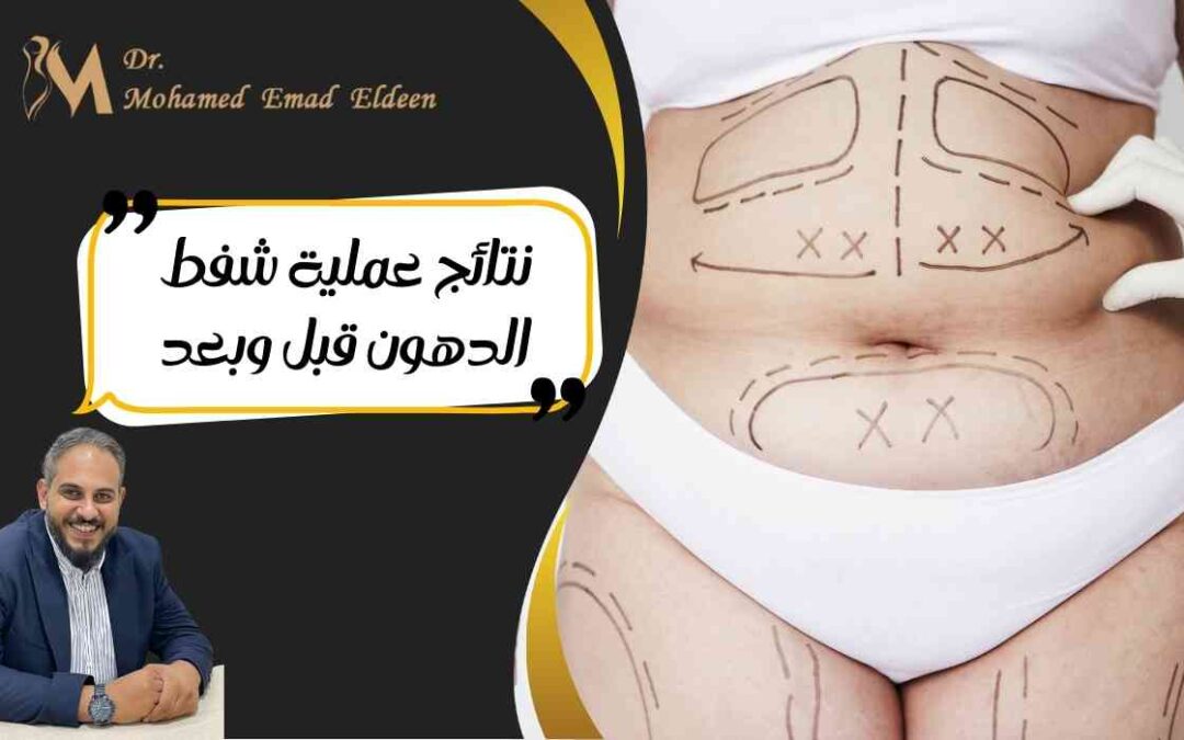 نتائج عملية شفط الدهون قبل وبعد