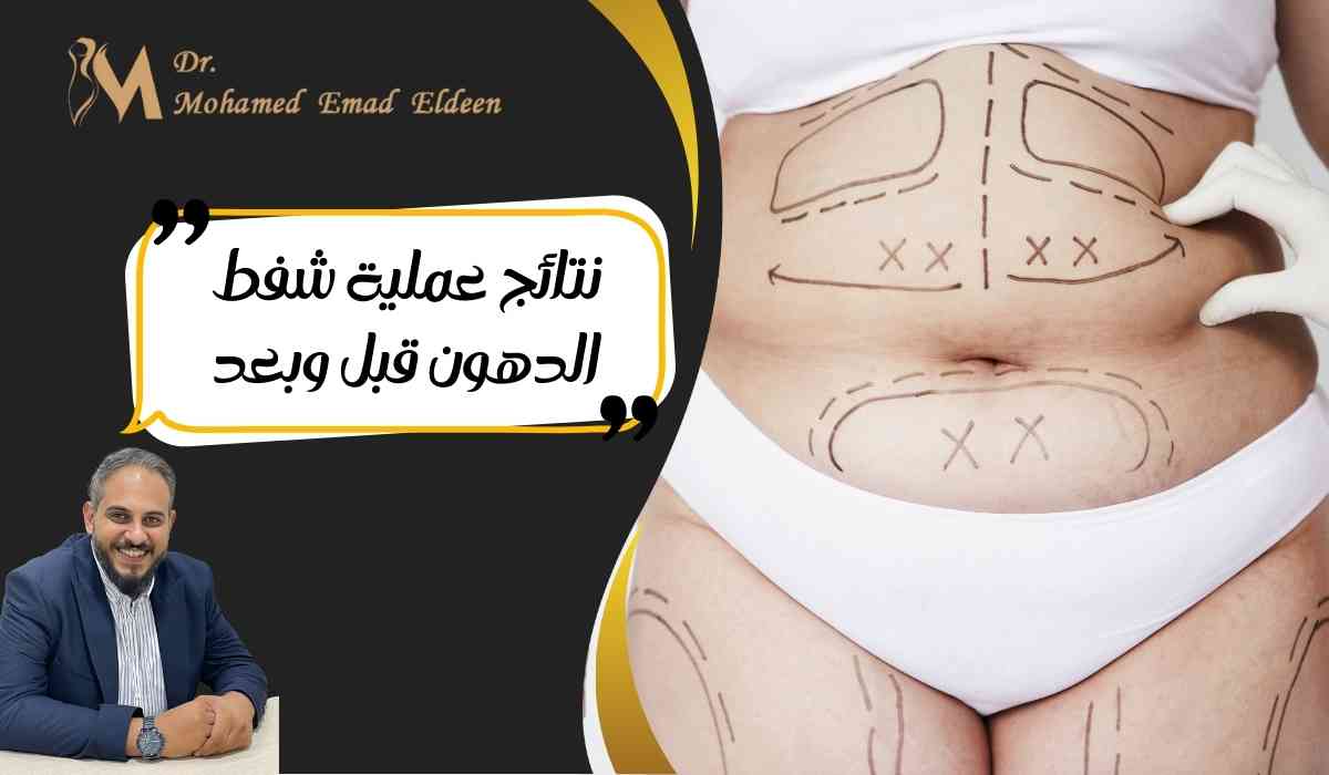 نتائج-عملية-شفط-الدهون-قبل-وبعد