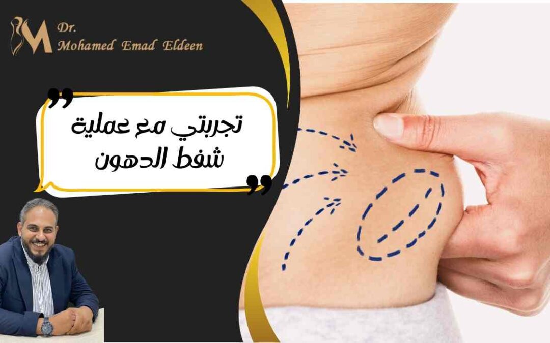 تجربتي مع عملية شفط الدهون