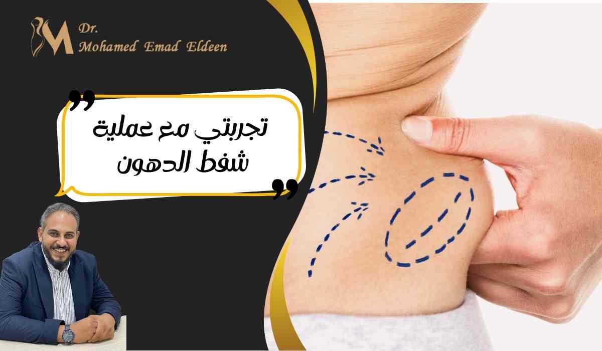 تجربتي-مع-عملية-شفط-الدهون