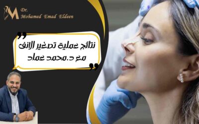 نتائج عملية تصغير الانف مع د.محمد عماد