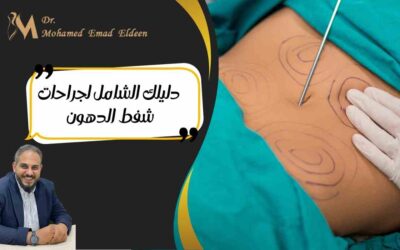 دليلك الشامل لجراحات شفط الدهون