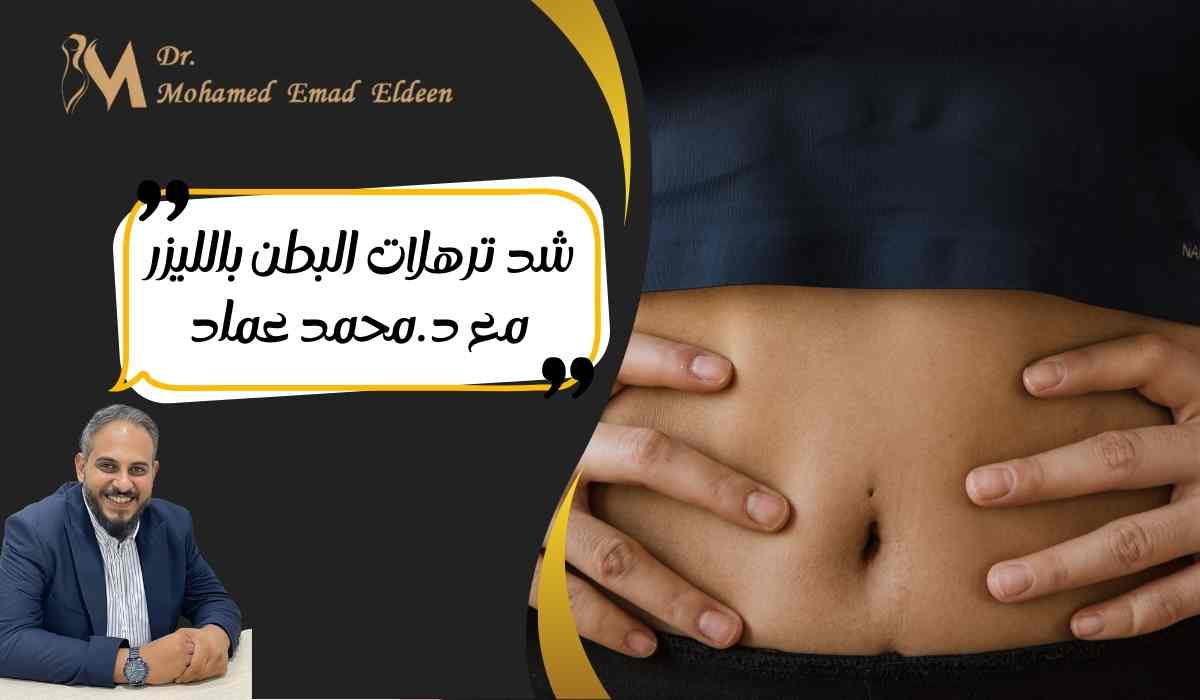 شد-ترهلات-البطن-بالليزر-مع-د-محمد-عماد