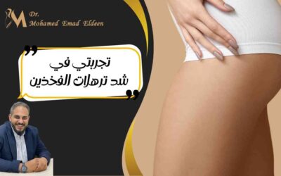 تجربتي في شد ترهلات الفخذين