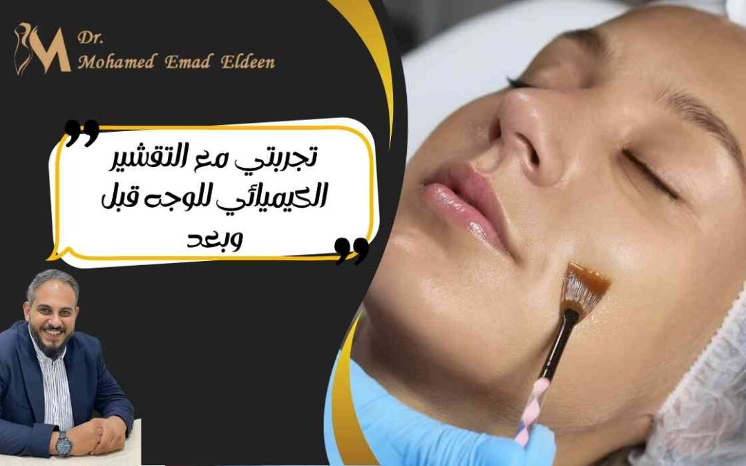 تجربتي مع التقشير الكيميائي للوجه قبل وبعد