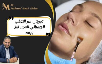 تجربتي مع التقشير الكيميائي للوجه قبل وبعد