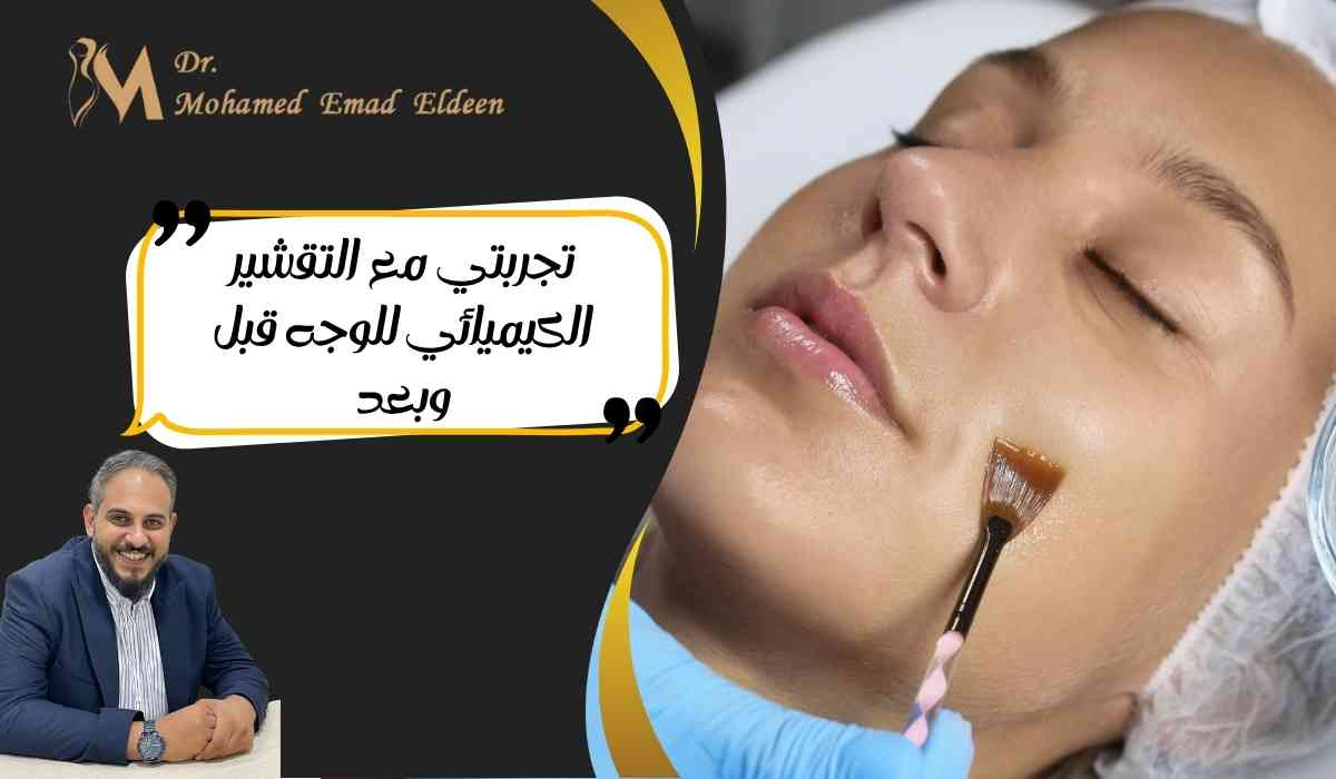 تجربتي-مع-التقشير-الكيميائي-للوجه-قبل-وبعد