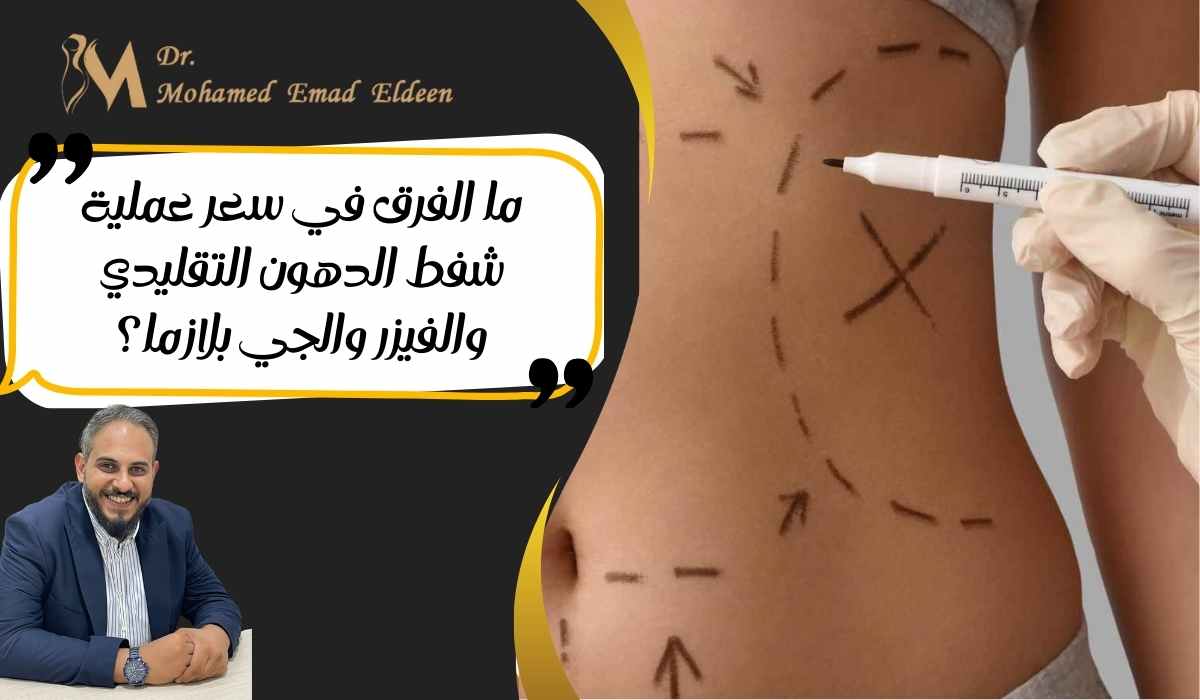 سعر-عملية-شفط-الدهون-التقليدي