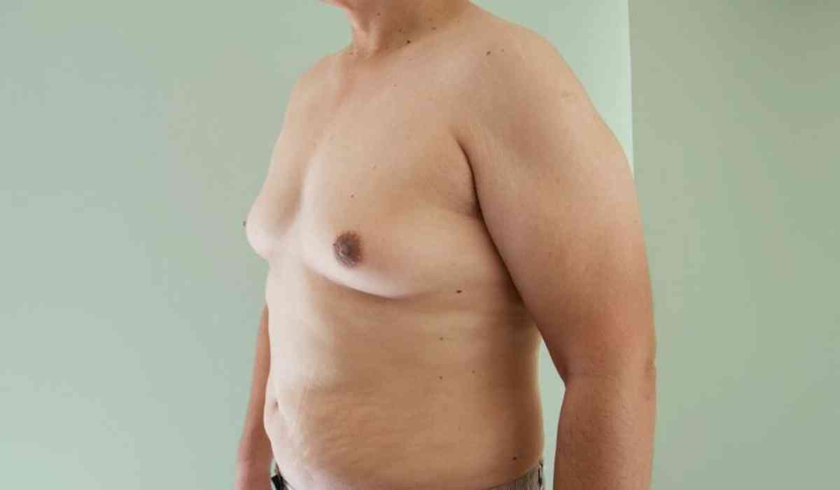 طرق-علاج-التثدي-عند-الرجال