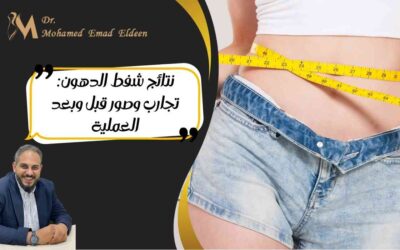 نتائج شفط الدهون: تجارب وصور قبل وبعد العملية