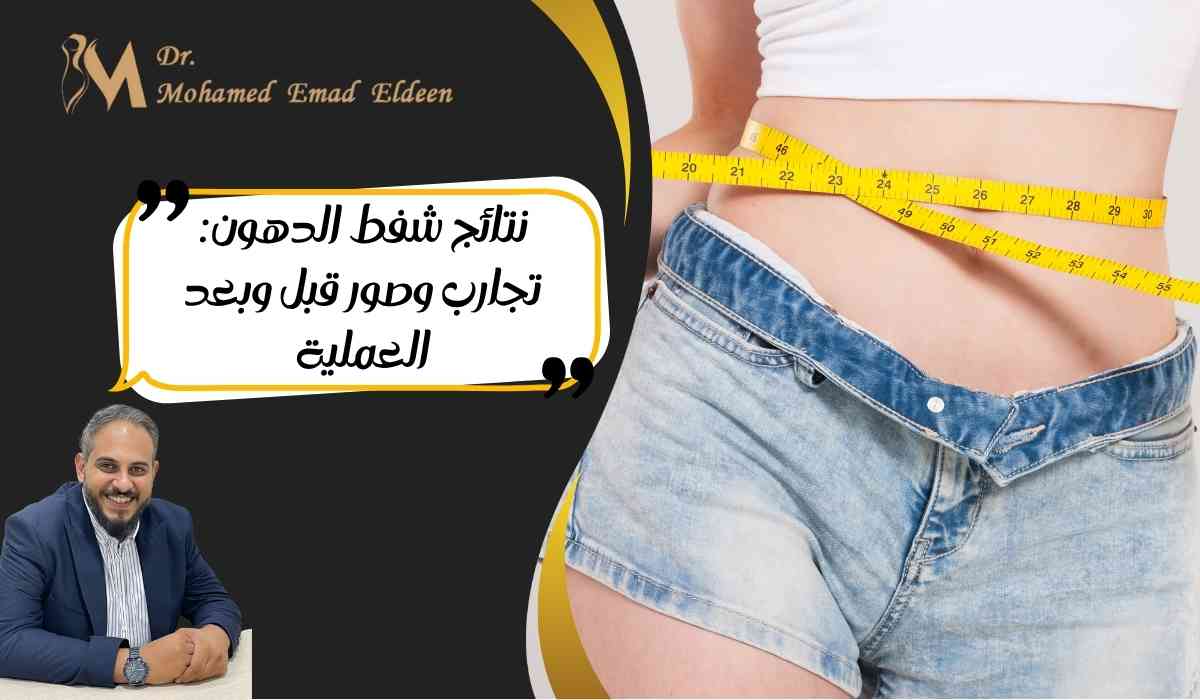نتائج-شفط-الدهون