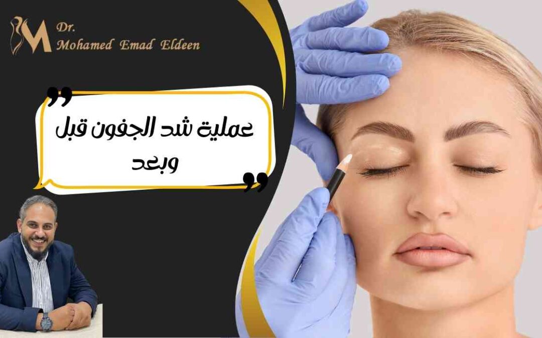 عملية شد الجفون قبل وبعد