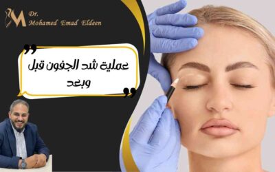 عملية شد الجفون قبل وبعد