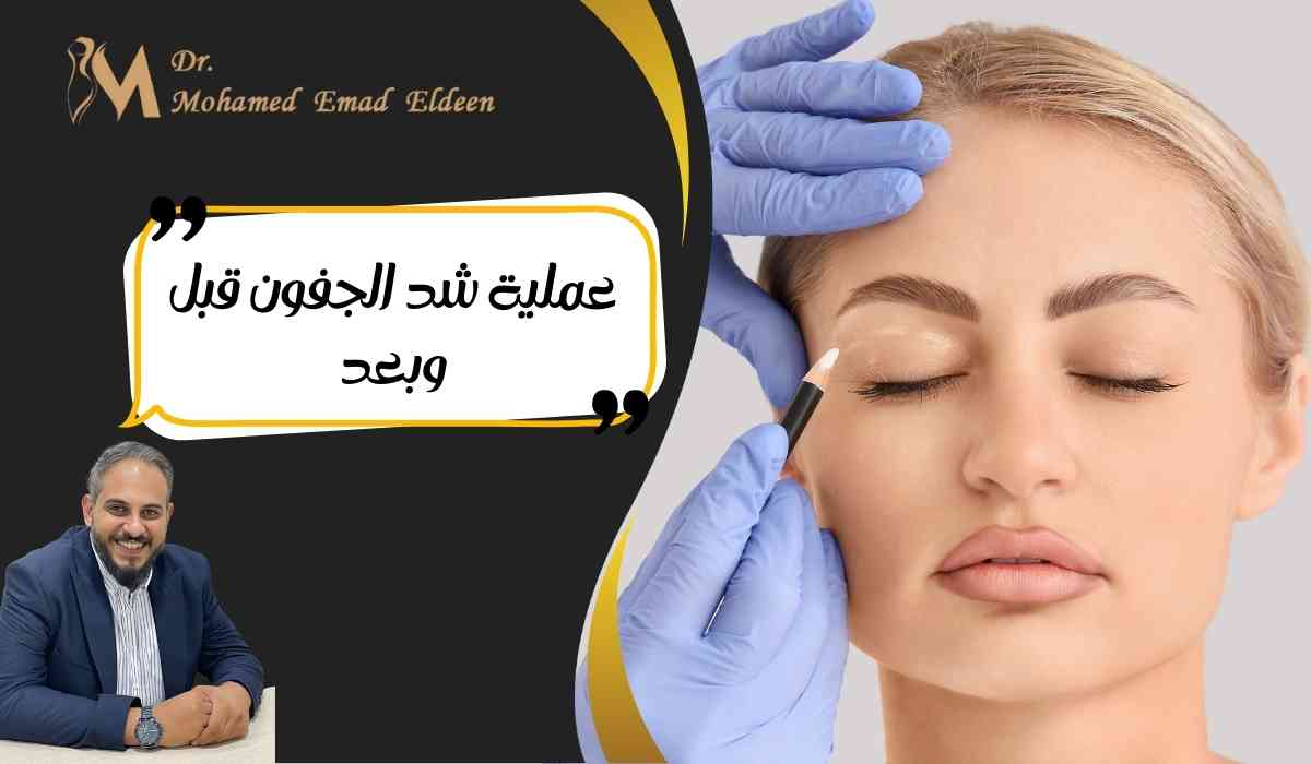 عملية-شد-الجفون-قبل-وبعد عملية-شد-الجفون-قبل-وبعد