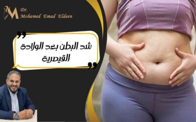 شد البطن بعد الولادة القيصرية