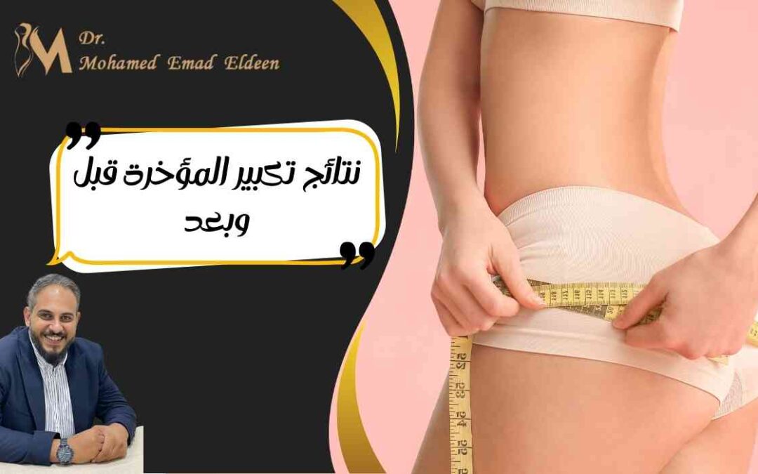 نتائج تكبير المؤخرة قبل وبعد