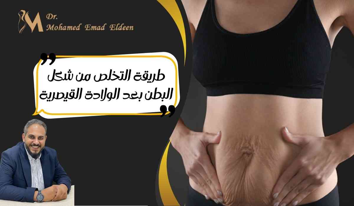 حل-شكل-البطن-بعد-الولادة-القيصرية