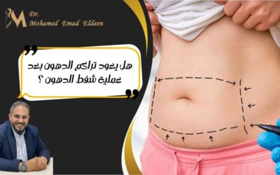 هل يعود تراكم الدهون بعد عملية شفط الدهون؟