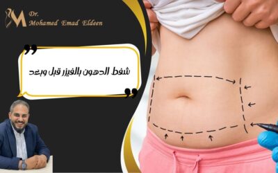 شفط الدهون بالفيزر قبل وبعد