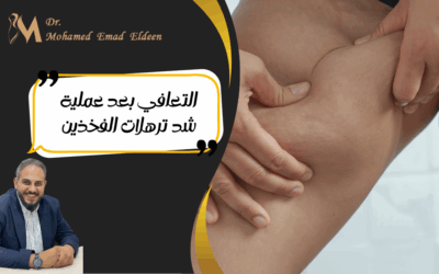 التعافي بعد عملية شد ترهلات الفخذين