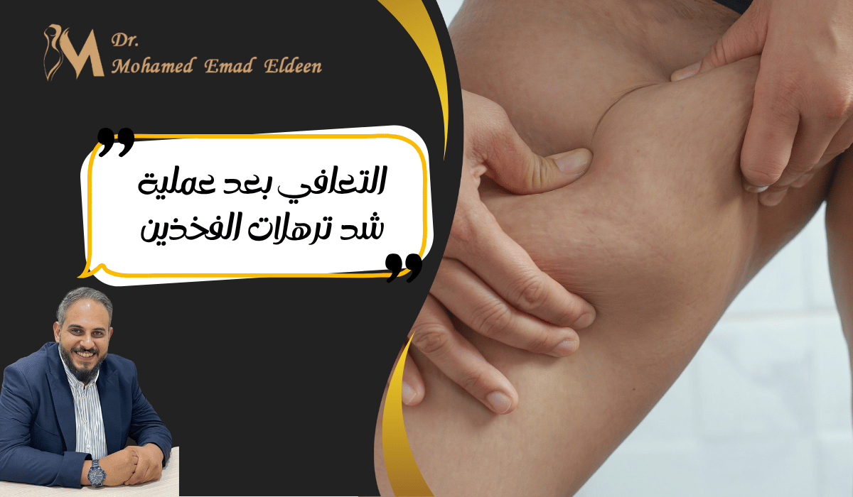 التعافي بعد عملية شد ترهلات الفخذين التعافي بعد عملية شد ترهلات الفخذين